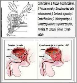 Prostate Cancer Treatment and Cure.