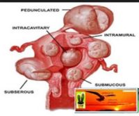 What cures Fibroids Naturally