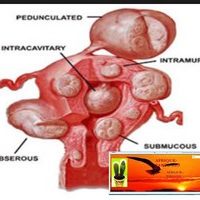 What cures Fibroids Naturally