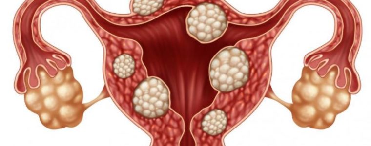 377- Fibroid and Treatments, Myomas: Plants against Fibroids