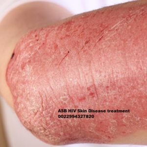 HIV skin disease