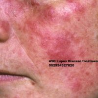 Lupus treatment