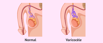 Varicocele: definition, causes, treatments