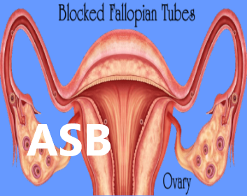 363- How to Unblock Fallopian Tubes Naturally and Get Pregnant