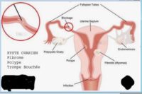 Fibroids Natural Treatment To Heal Fibroids Definitively