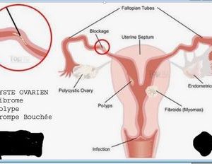 Fibroids Natural Treatment To Heal Fibroids Definitively