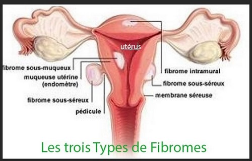 Myomas Fibroids How to Treat Fibroids Naturally?