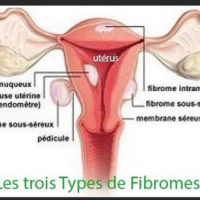 Natural Treatment for Fibroid Natural Remedy to Shrink Fibroid