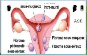 Uterine fibroids and food