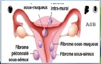 225- What Diet Shrinks Fibroids : Natural Remedy Uterine Fibroids