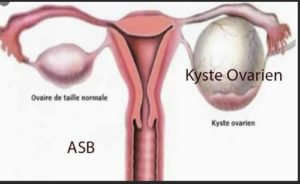 What is Ovarian Cyst