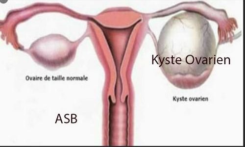 What is Ovarian Cyst