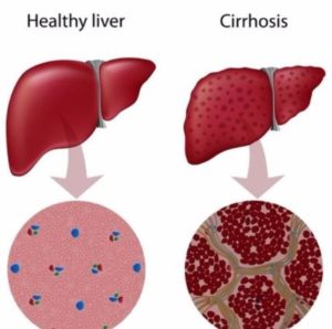 Liver The Role of Liver Hepatitis B and Liver