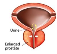 Prostatitis Natural Traitement Prostatitis to Heal Prostatitis