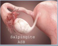 Salpingitis Natural Treatment
