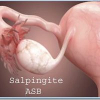 Salpingitis Natural Treatment