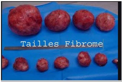 220- My Fibroma Has Disappeared Naturally : Natural Treatments for Fibroids