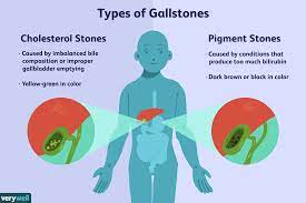 137- Gallstones Remedy With Plants Gallstones Natural Treatment