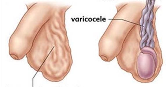 306- How to Treat Varicocele : Recipes for curing varicocele Naturally