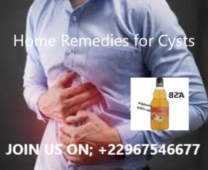 Home Remedies for Cysts