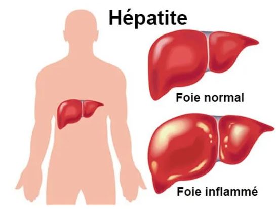 How to Cure Hepatitis B? Natutal Treatment Hepatitis B